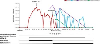 Donor-derived cytomegalovirus-cytotoxic T lymphocytes and leflunomide successfully control refractory cytomegalovirus infections and disease of multiple sites after allogeneic-hematopoietic stem cell transplantation: A case report